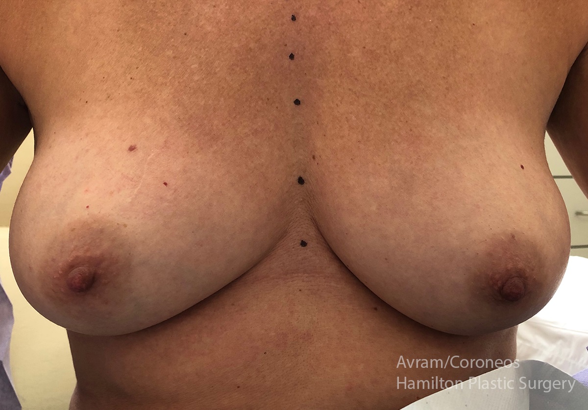 Dr. Ronen Avram Cosmetic & Reconstructive Breast Surgeon